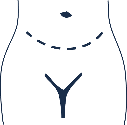 Abdominoplastyka — plastyka brzucha po odchudzaniu i po ciąży