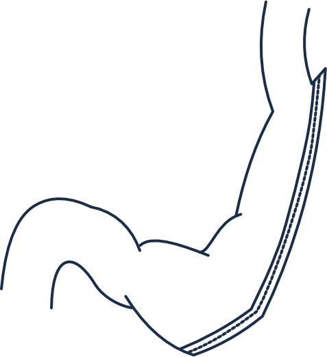 Chirurgia bariatryczna — rękawowa resekcja żołądka (sleeve gastrectomy)